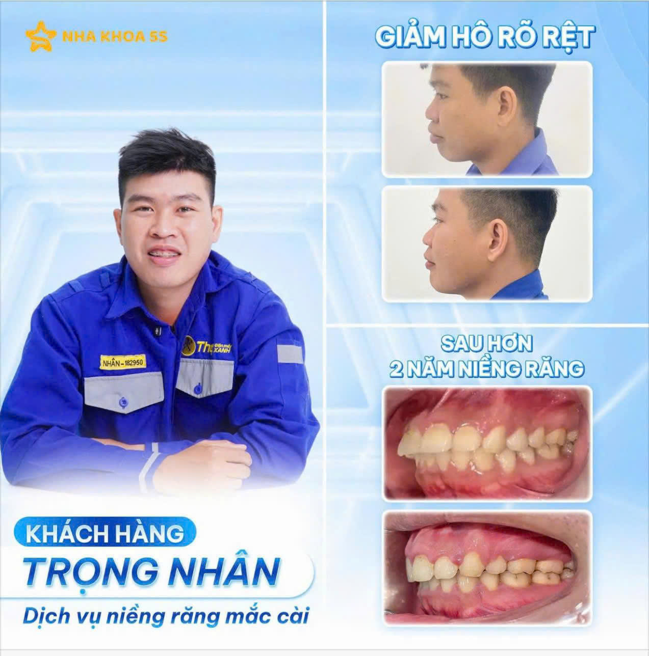 giá niềng răng mắc cài