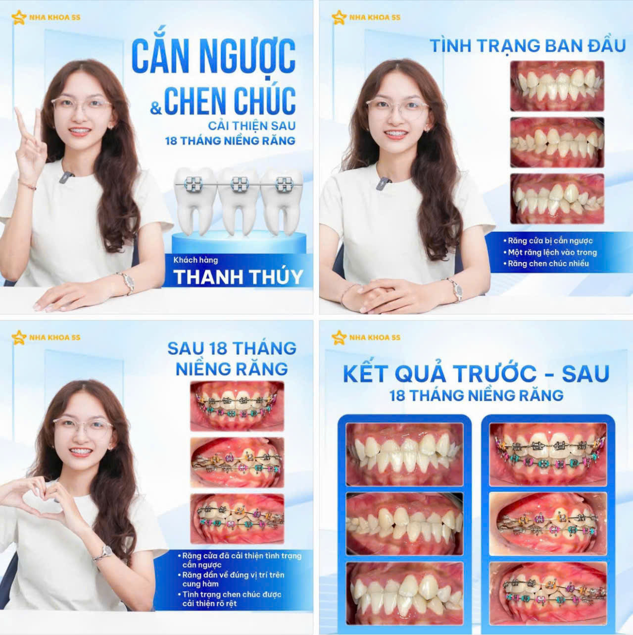giá niềng răng mắc cài
