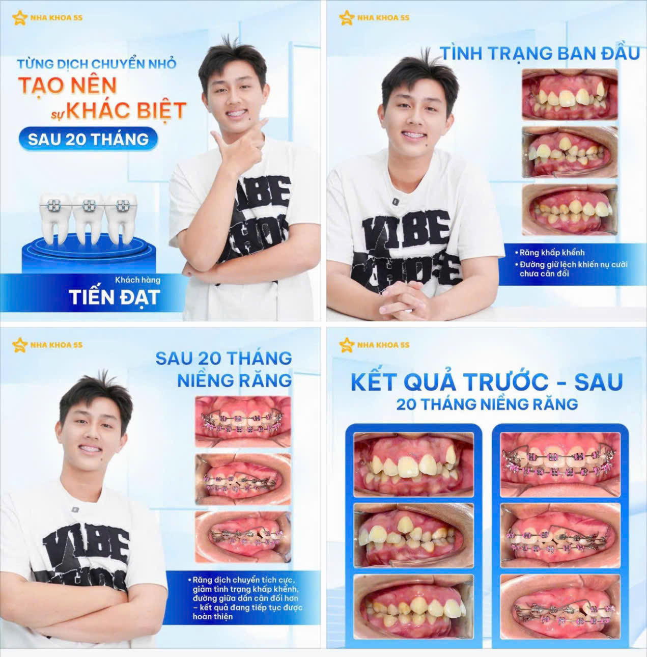 giá niềng răng mắc cài